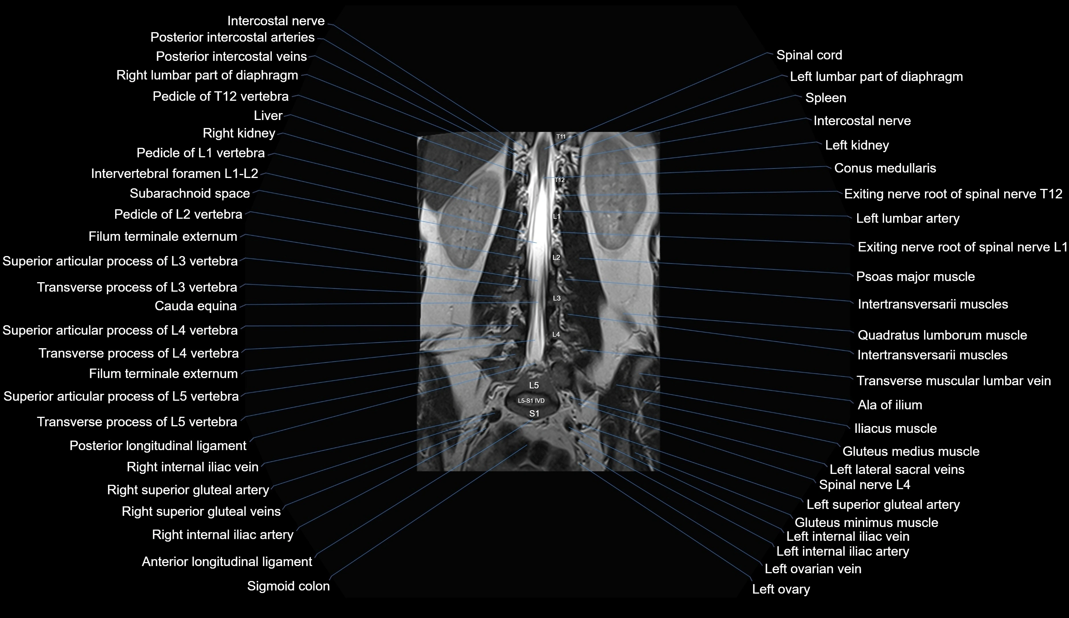 MRI lumbar spine coronal cross sectional anatomy 3T radiology  image-img-00001-00019.webp